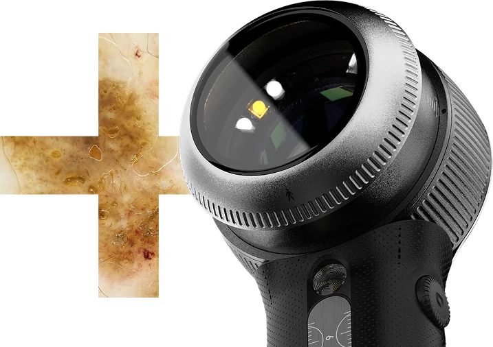 Your Plus in Dermoscopy - DermLite DL5 Plus