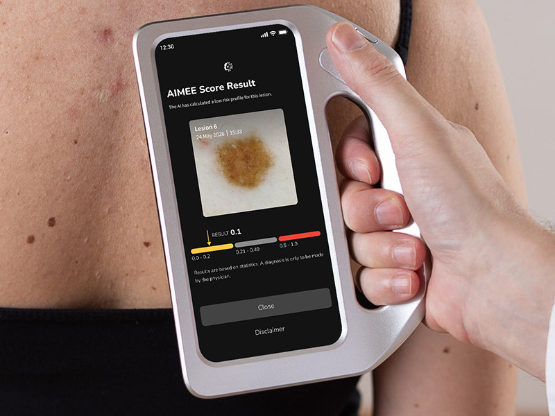 FotoFinder AI score on DermLite skeen